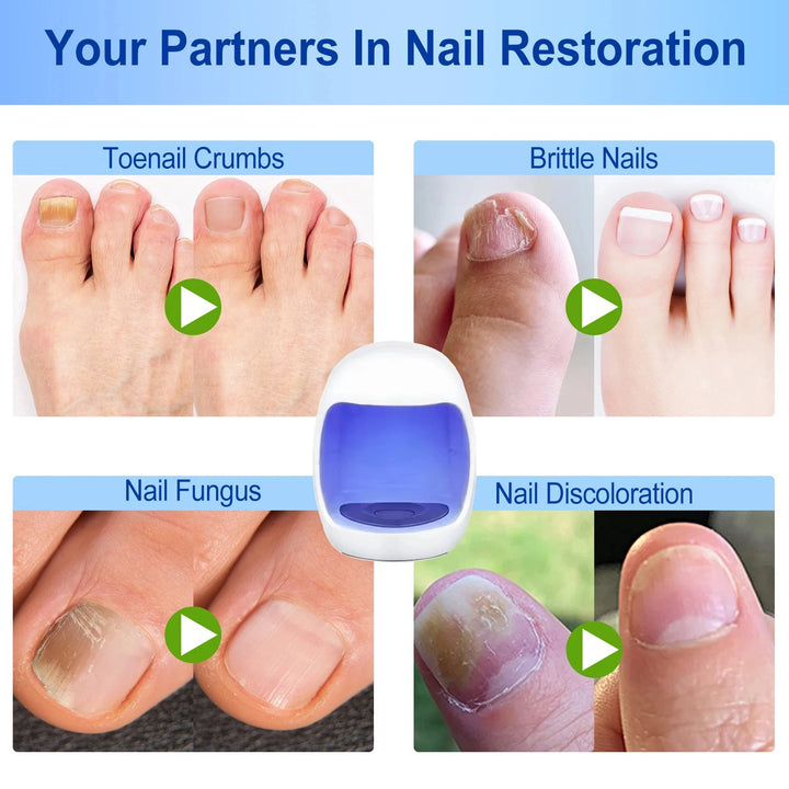 Toenail Nail Fungus Treatment Repair Fingernail Device Toenail Treatment for Foot Nail Fungus Essential Oil Onychomycosis Care